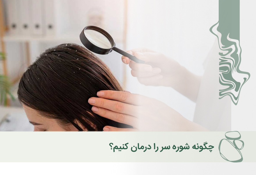 چگونه شوره سر را درمان کنیم؟